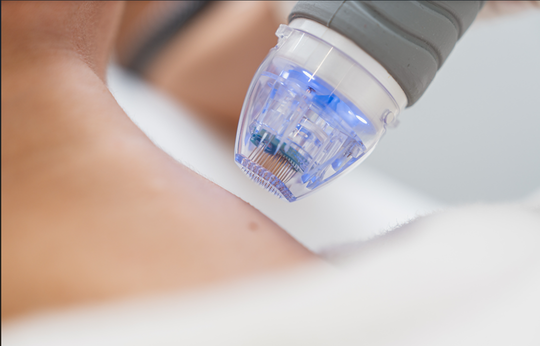 microneedling noblesville indiana