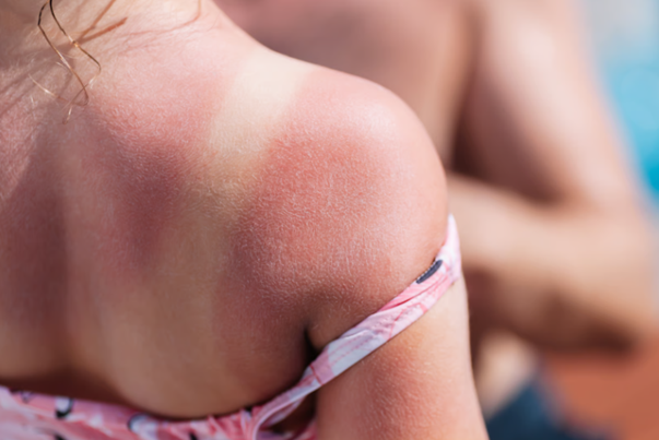 Summer Skin Care in Noblesville Indiana: Protect & Repair Sun-Damaged Skin